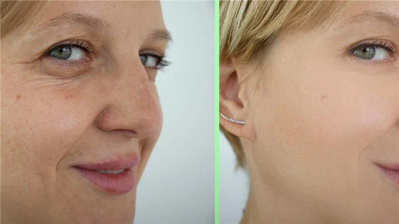 Skin tightening surgery